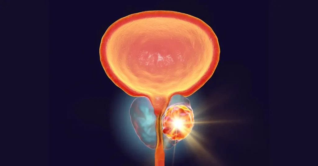 Early Bladder Cancer Symptoms